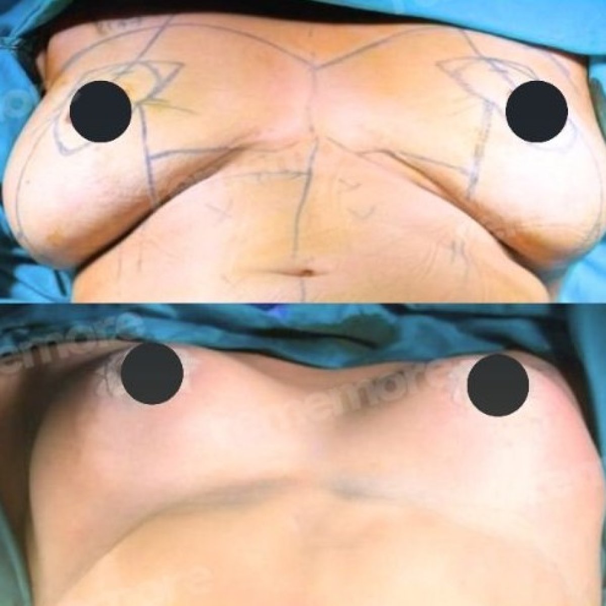 Before and after breast implants with lift at Memorial Şişli Hospital, enhanced breast contour result