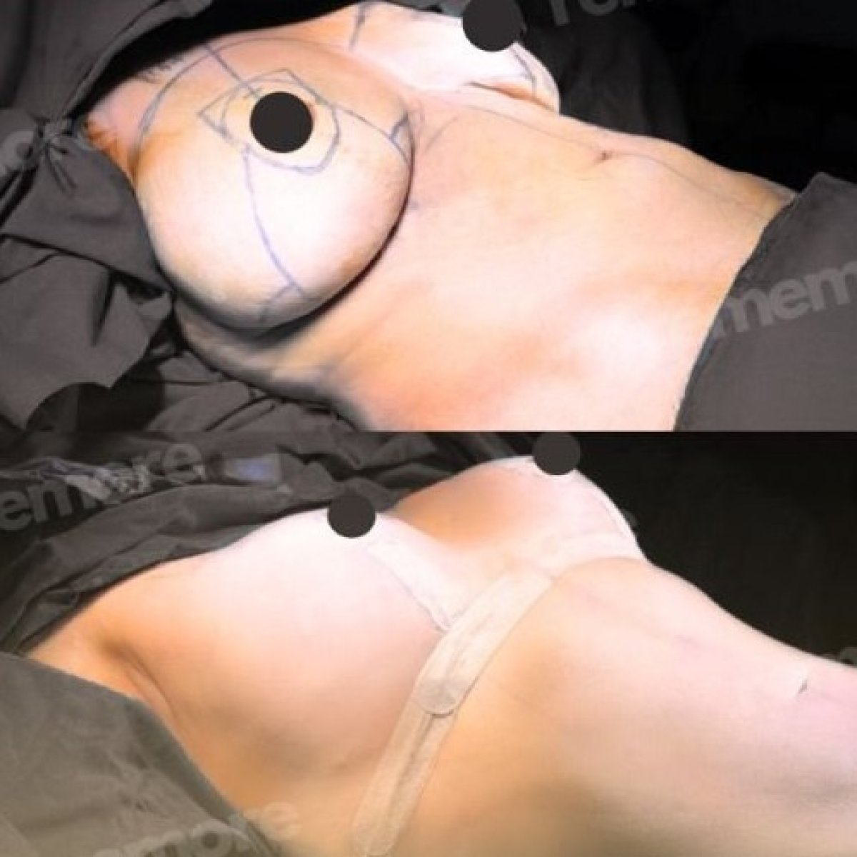 Before and after breast implants with breast lift results at Memorial Şişli Hospital