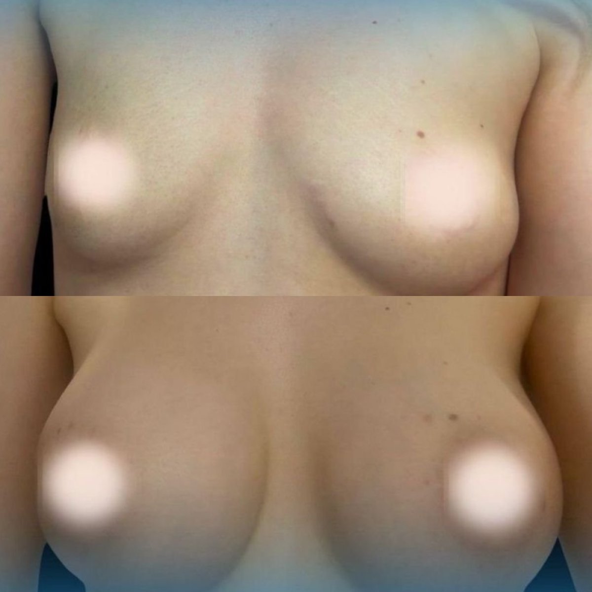 Before and after breast implants with lift results at Memorial Şişli Hospital, enhanced contour