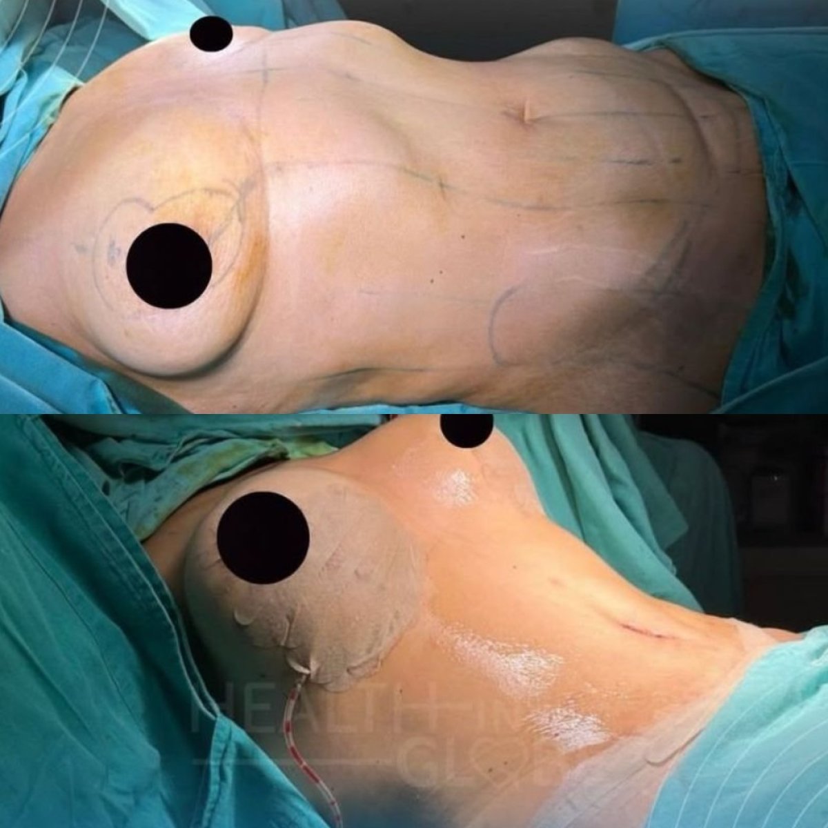 Before and after breast implants with breast lift results at Memorial Şişli Hospital