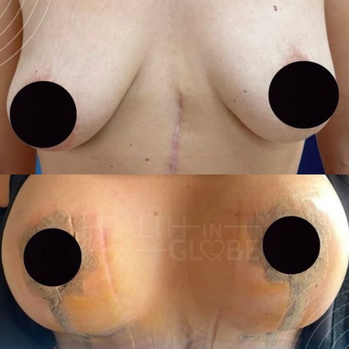 Before and after breast implants with lift at Memorial Şişli Hospital, enhanced breast shape result