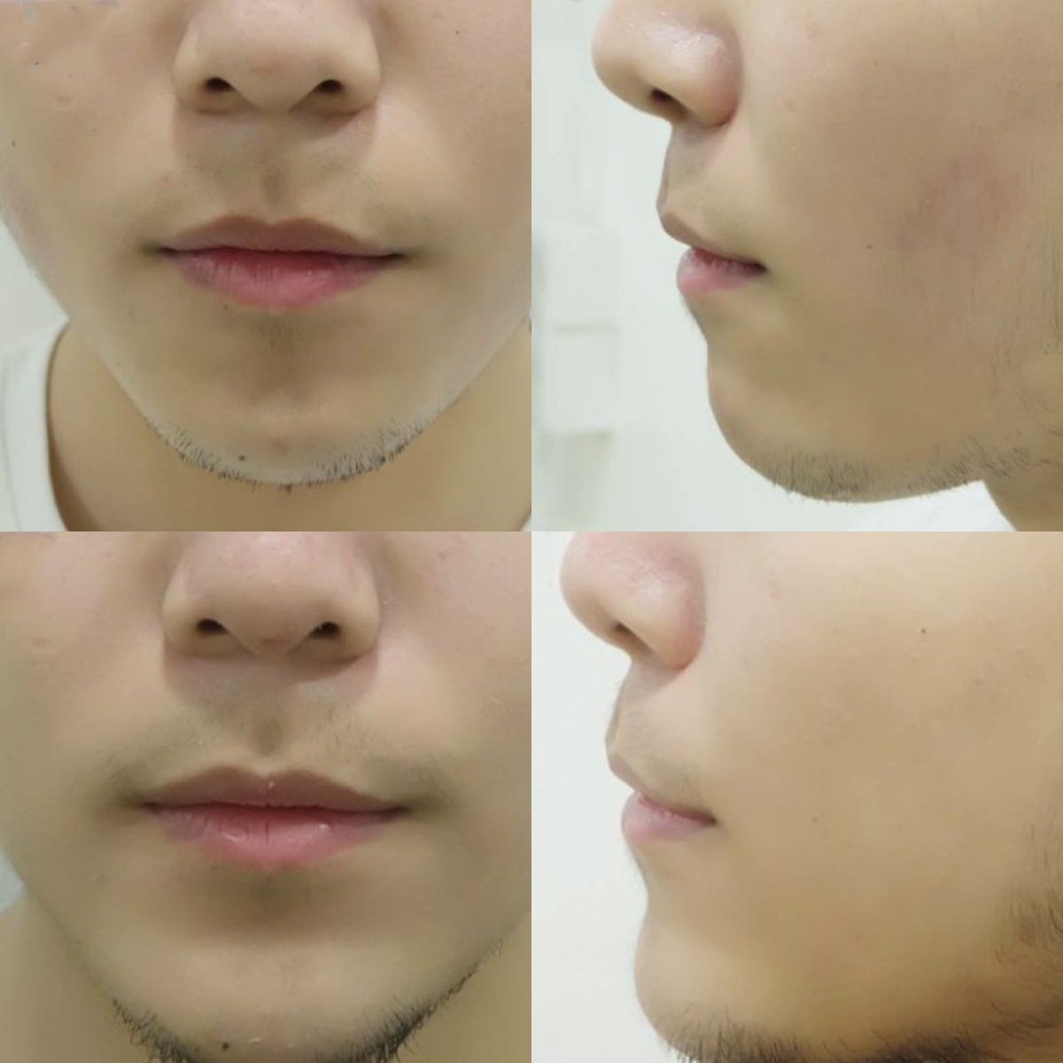 Before and after chin augmentation results at Somchai Clinic, improved chin contour visible