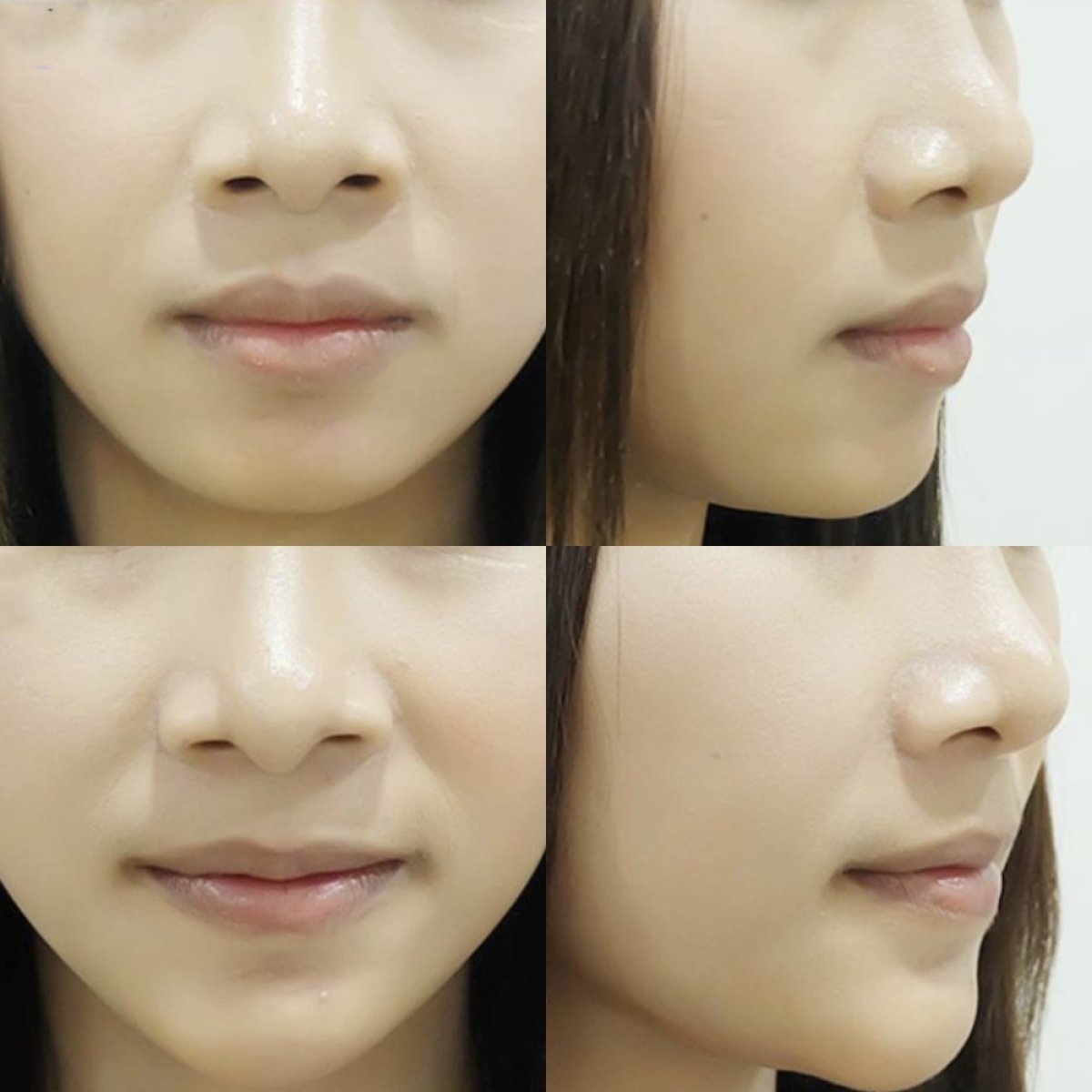 Before and after chin augmentation results at Somchai Clinic, enhanced chin profile visible