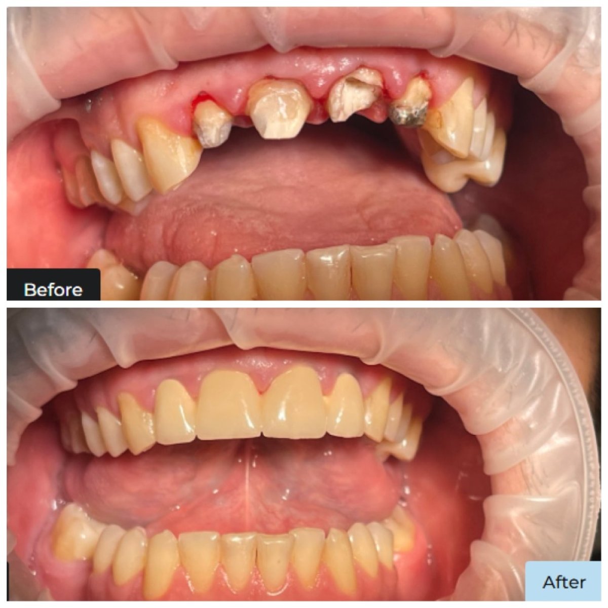 نتائج ترميم الأسنان بالترابط قبل وبعد في عيادة Dental Clinic Dynasty Stomatology كراكوف