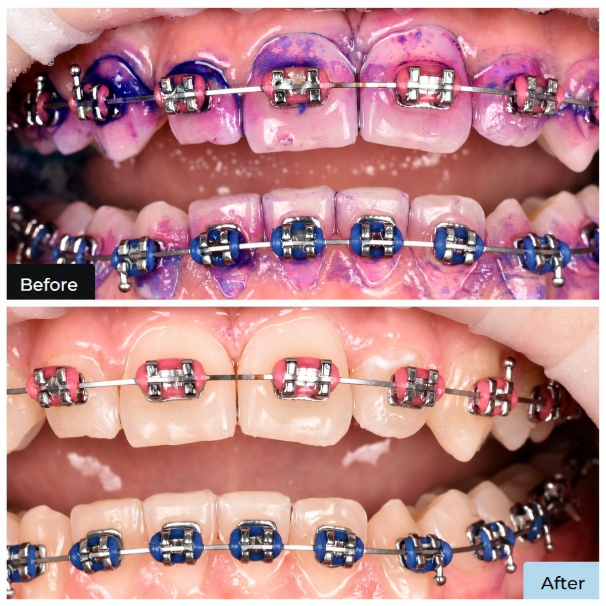 نتائج تنظيف الأسنان (إزالة الجير) مع التقويم في عيادة Dental Clinic Dynasty Stomatology كراكوف
