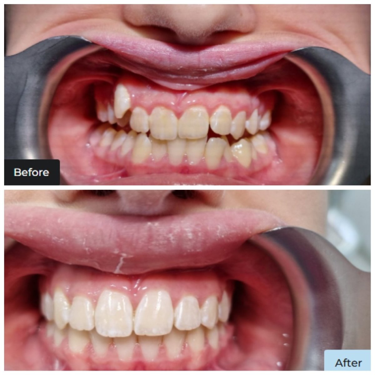 نتيجة قبل وبعد التقويم الشفاف في عيادة Dental Clinic Dynasty Stomatology كراكوف