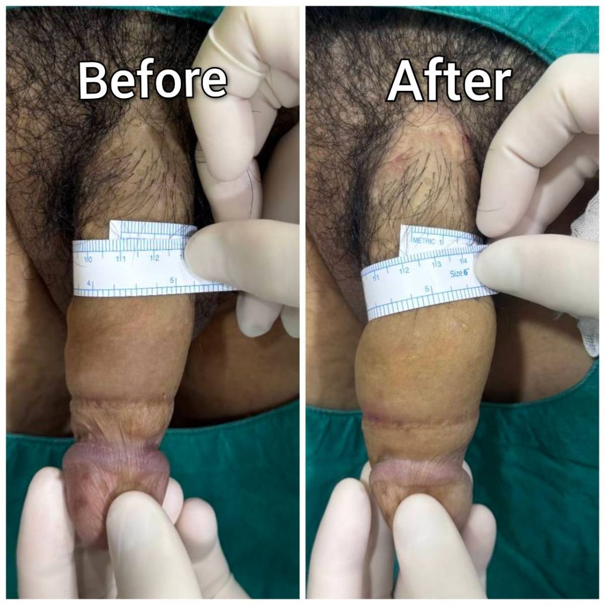 Before and after penis filler results at Eternity Clinic Pleonchit, visible girth enhancement