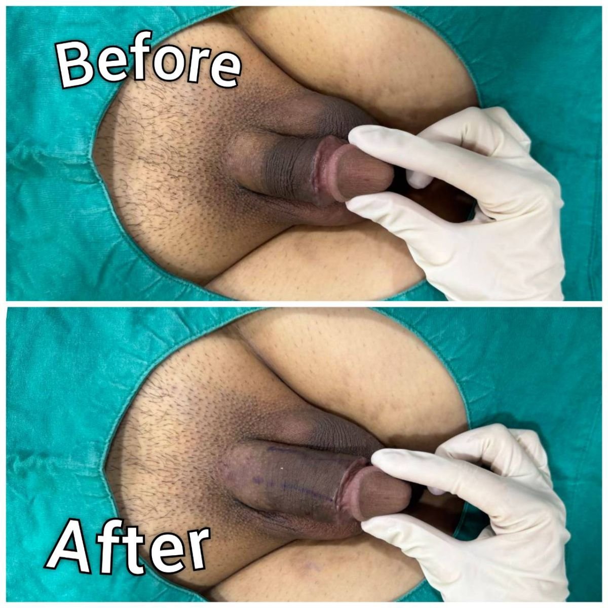 Before and after penis filler results at Eternity Clinic Pleonchit, visible enhancement achieved