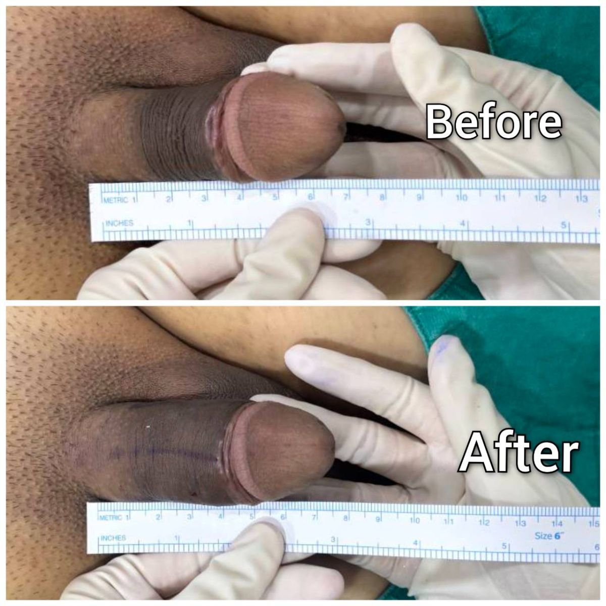 Penis-Filler vor und nach Fotos | Bookimed