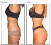 Before and after Brazilian Butt Lift photos by Dr. Dr Phatcharasak Kraisornphongsakul Md