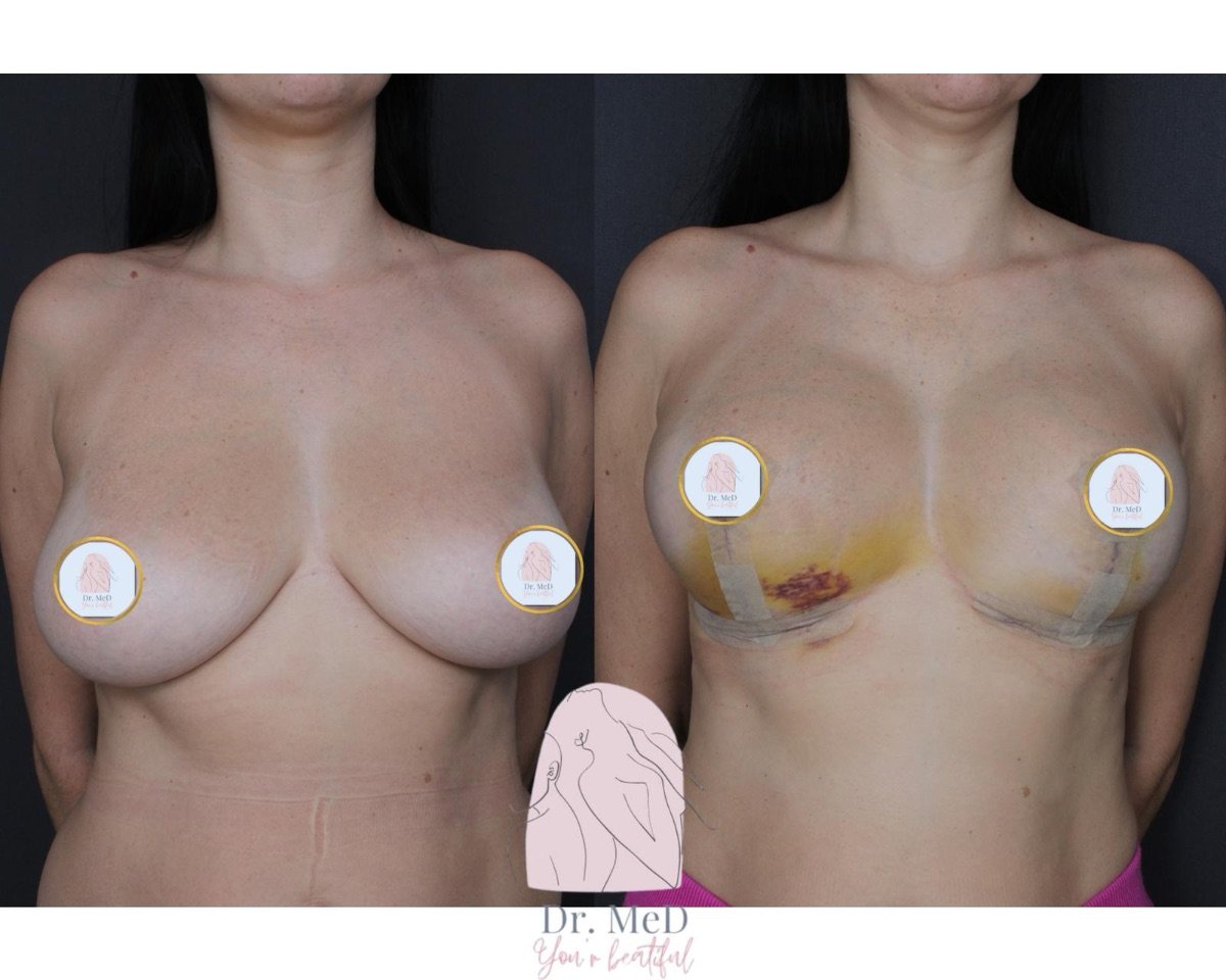 قبل وبعد تكبير الثدي في Dr. MED، تحسين واضح للشكل والحجم
