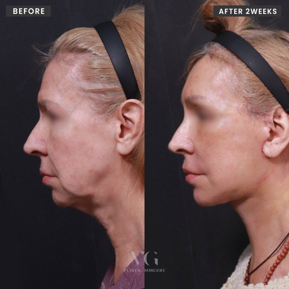 Результати ліпосакції до і після у VG Plastic Surgery, покращення лінії підборіддя та шиї