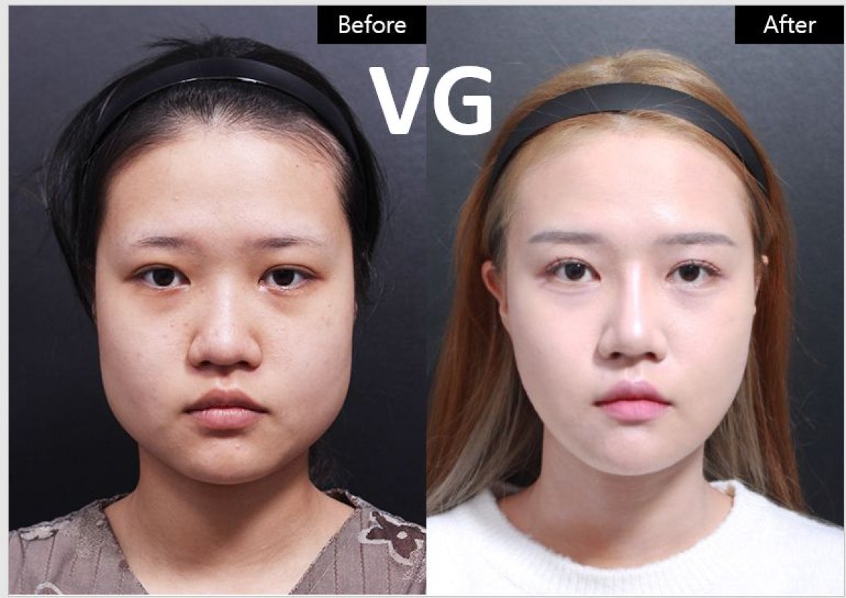 Vorher-nachher-Ergebnis der Gesichtskonturierung bei VG Plastic Surgery – definiertere Kieferlinie
