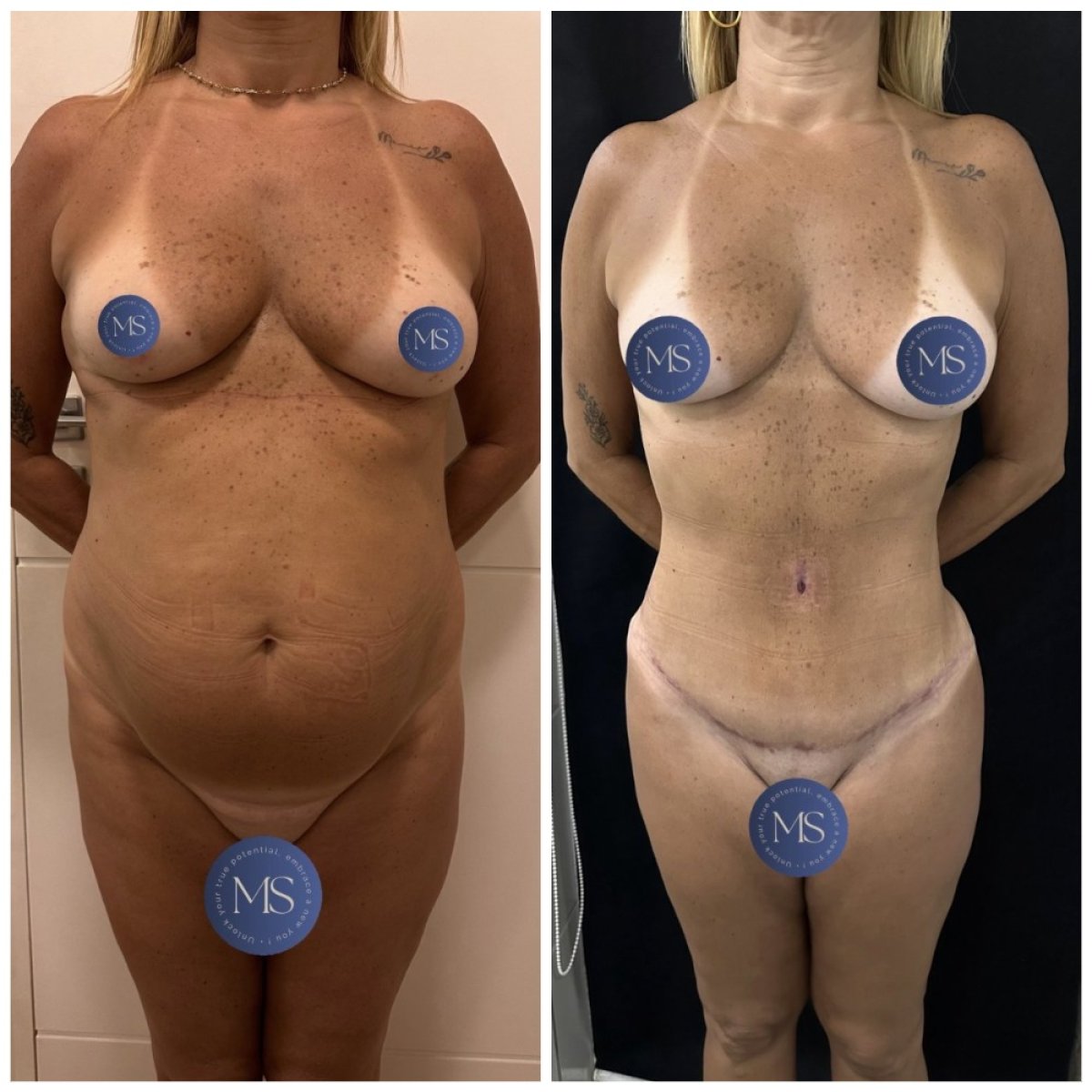 Resultados de liposucción antes y después en Dr. Michel Salameh - Plastic And Aesthetic Surgery, cintura más delgada