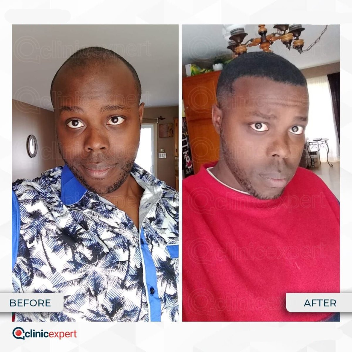 Afro hair transplant before and after results at CE International Hospital, fuller hairline