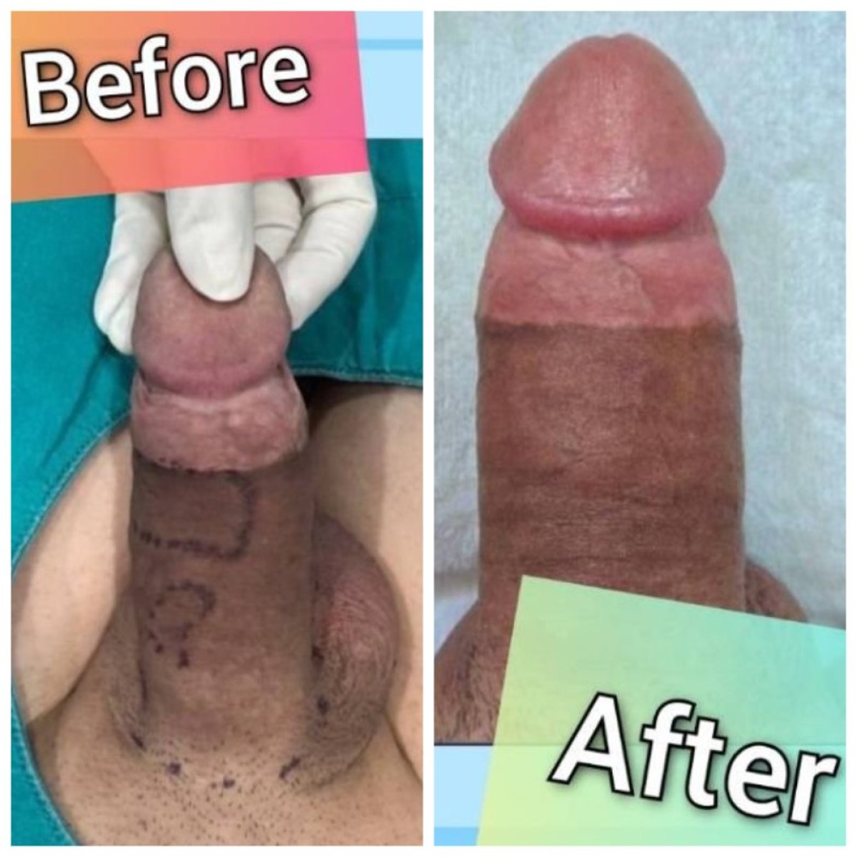نتائج تكبير القضيب قبل وبعد في Eternity Clinic Pleonchit، زيادة ملحوظة في الحجم