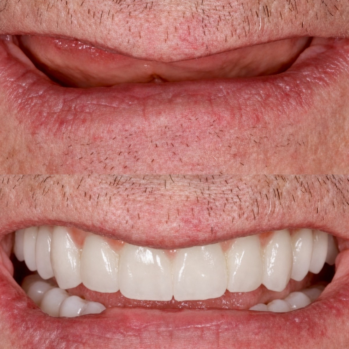 До та після імплантації зубів із седацією в BMC Dental Klinik, результат посмішки