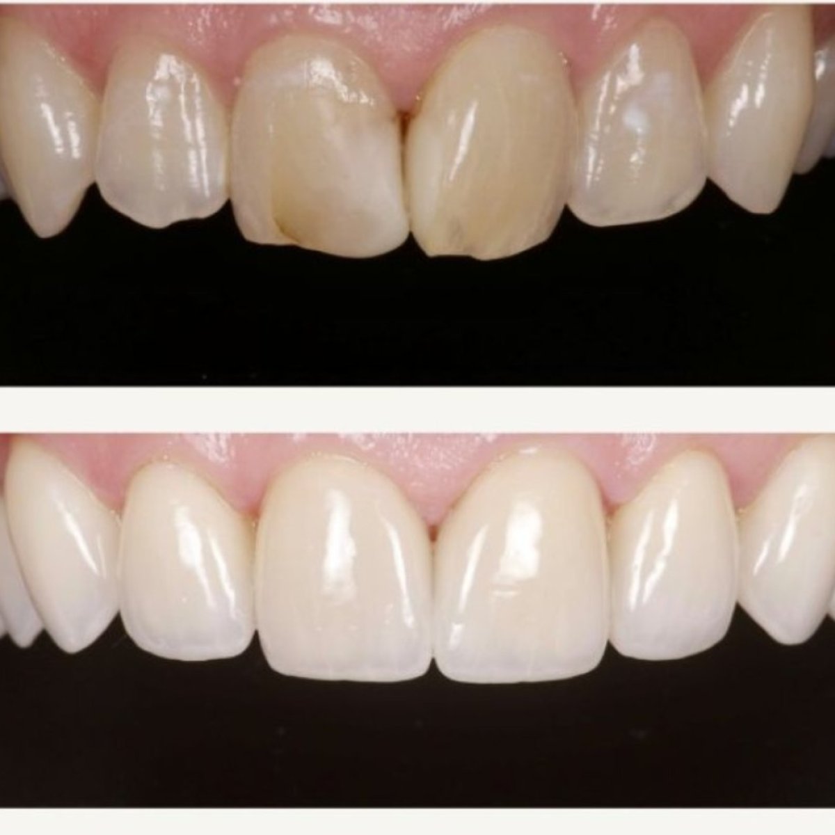 Before and after dental veneers at BMC Dental Klinik, smile makeover with natural results