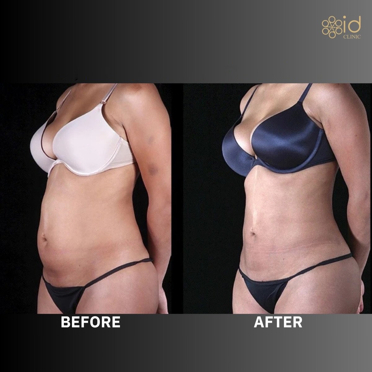 Before and after BodyTite body contouring results at ID Clinic Bangkok, visible slimmer waist