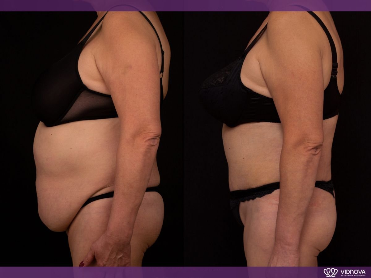 Resultados de liposucción antes y después en Vidnova Clinic – mejora visible del abdomen