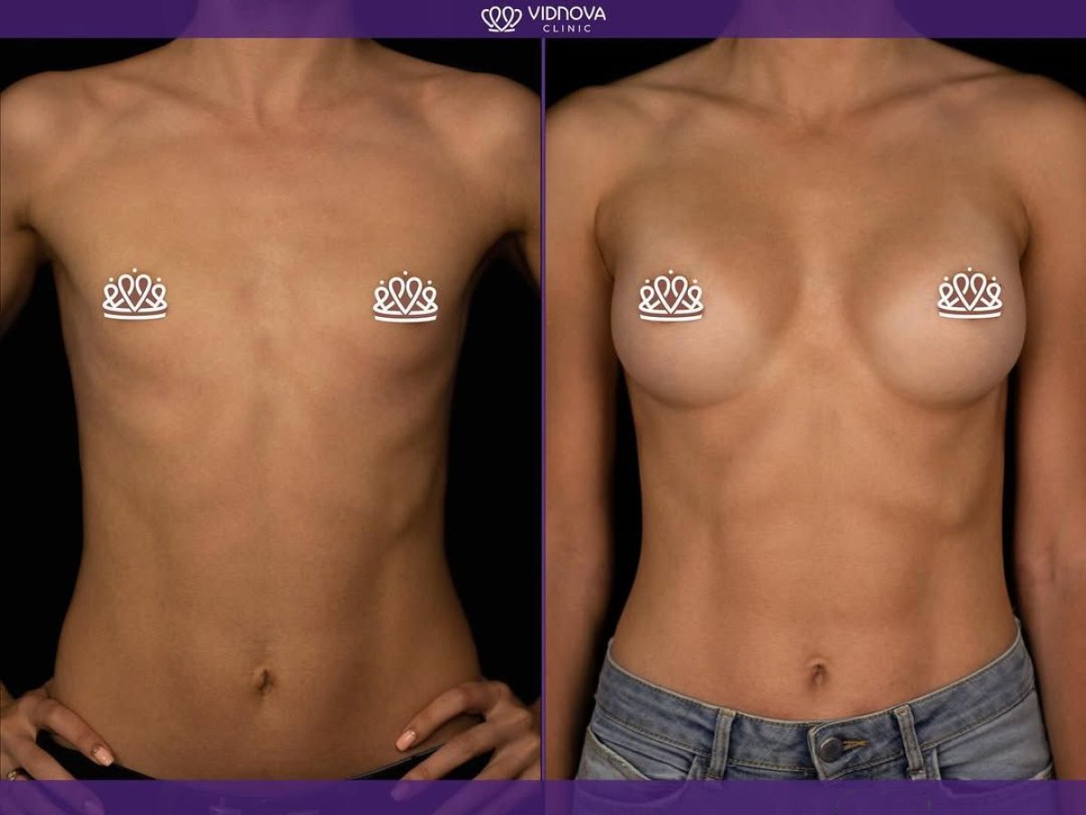 Before and after mammoplasty results at Vidnova Clinic – enhanced breast shape and volume