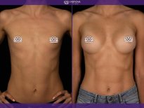 Before and after Mammoplasty photos by Dr. Yuriy Sydorchuk