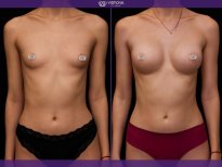 Before and after Mammoplasty photos by Dr. Yuriy Sydorchuk
