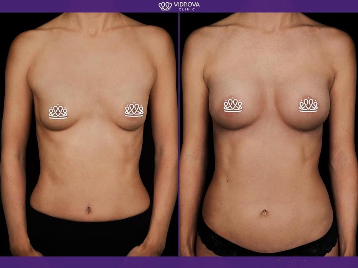 Before and after mammoplasty results at Vidnova Clinic – enhanced breast shape and volume