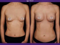 Before and after Mammoplasty photos by Dr. Yuriy Sydorchuk