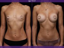 Before and after Mammoplasty photos by Dr. Yuriy Sydorchuk