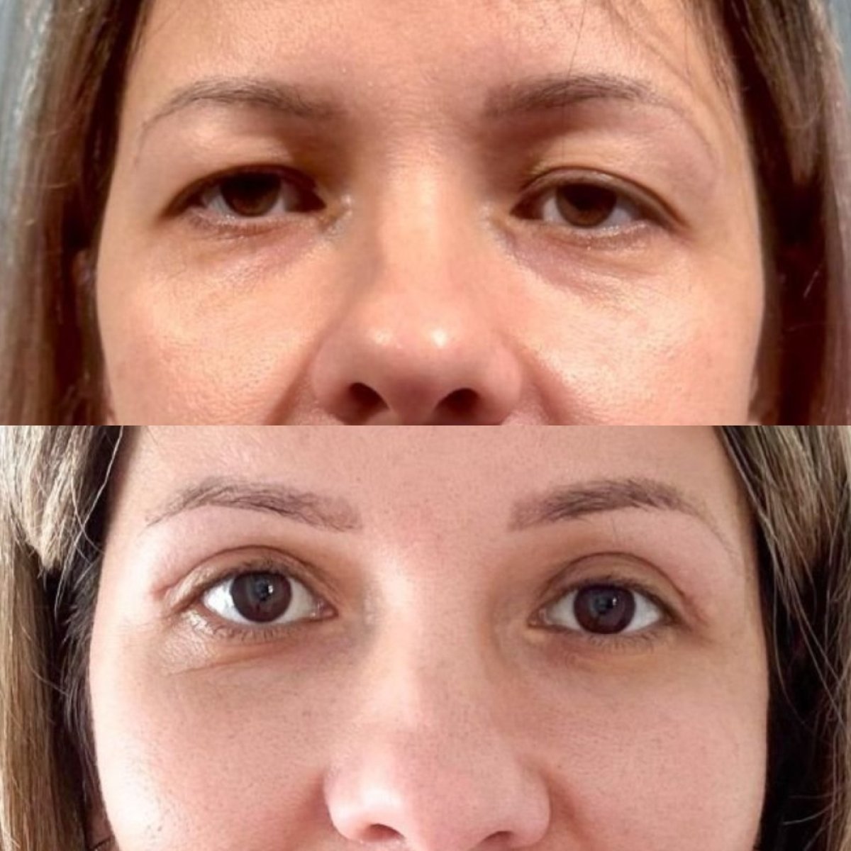 Resultados de blefaroplastia superior antes y después en Soraca Med Istanbul, ojos rejuvenecidos