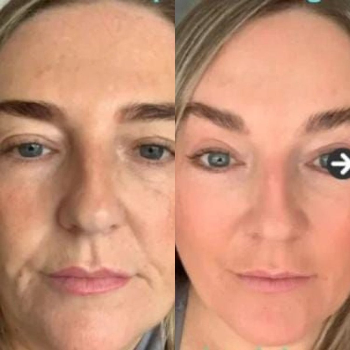 Before and after deep plane facelift results at Memorial Şişli Hospital, facial rejuvenation