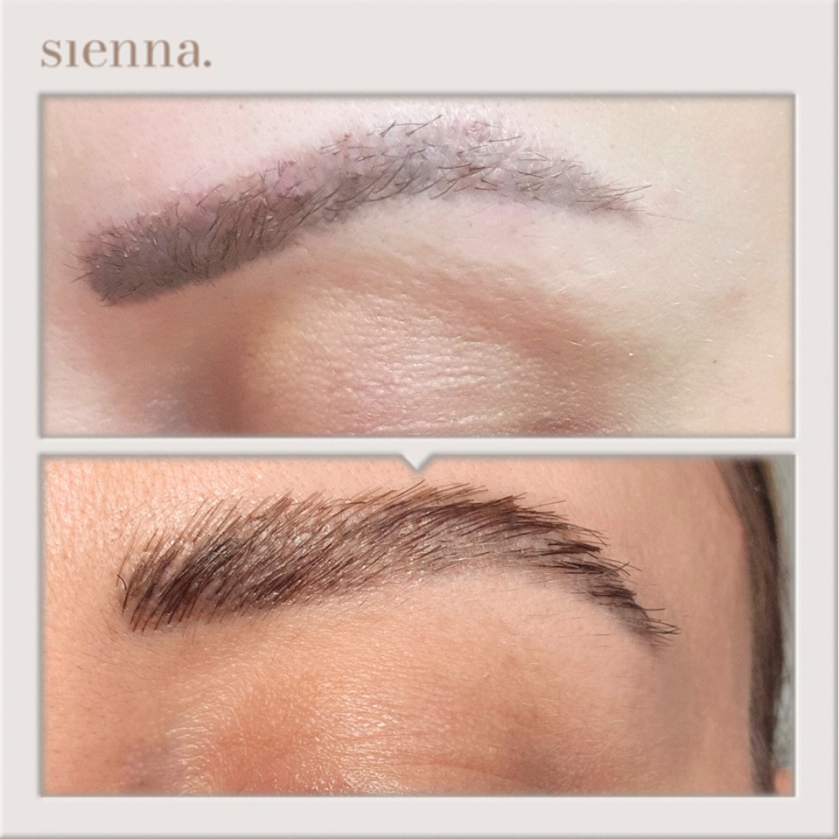 نتائج زراعة الحواجب قبل وبعد في Sienna Clinic – حواجب أكثر كثافة وطبيعية