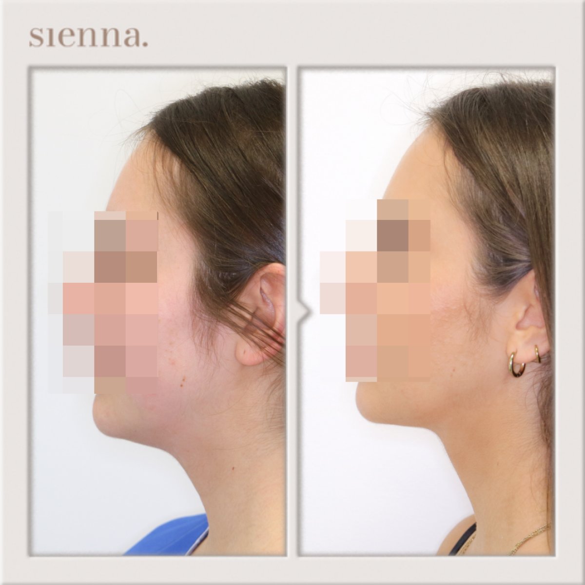 Resultados de liposucción antes y después en Sienna Clinic, mejora del contorno facial