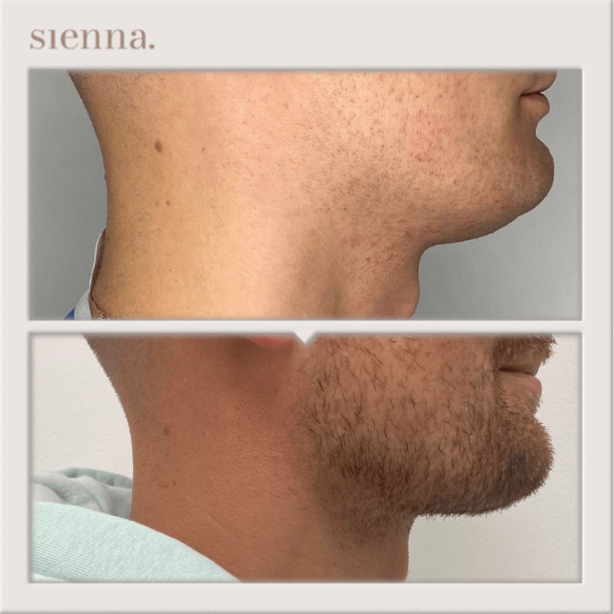 نتائج شفط الدهون قبل وبعد في Sienna Clinic، تحسين خط الفك وتحديد الرقبة