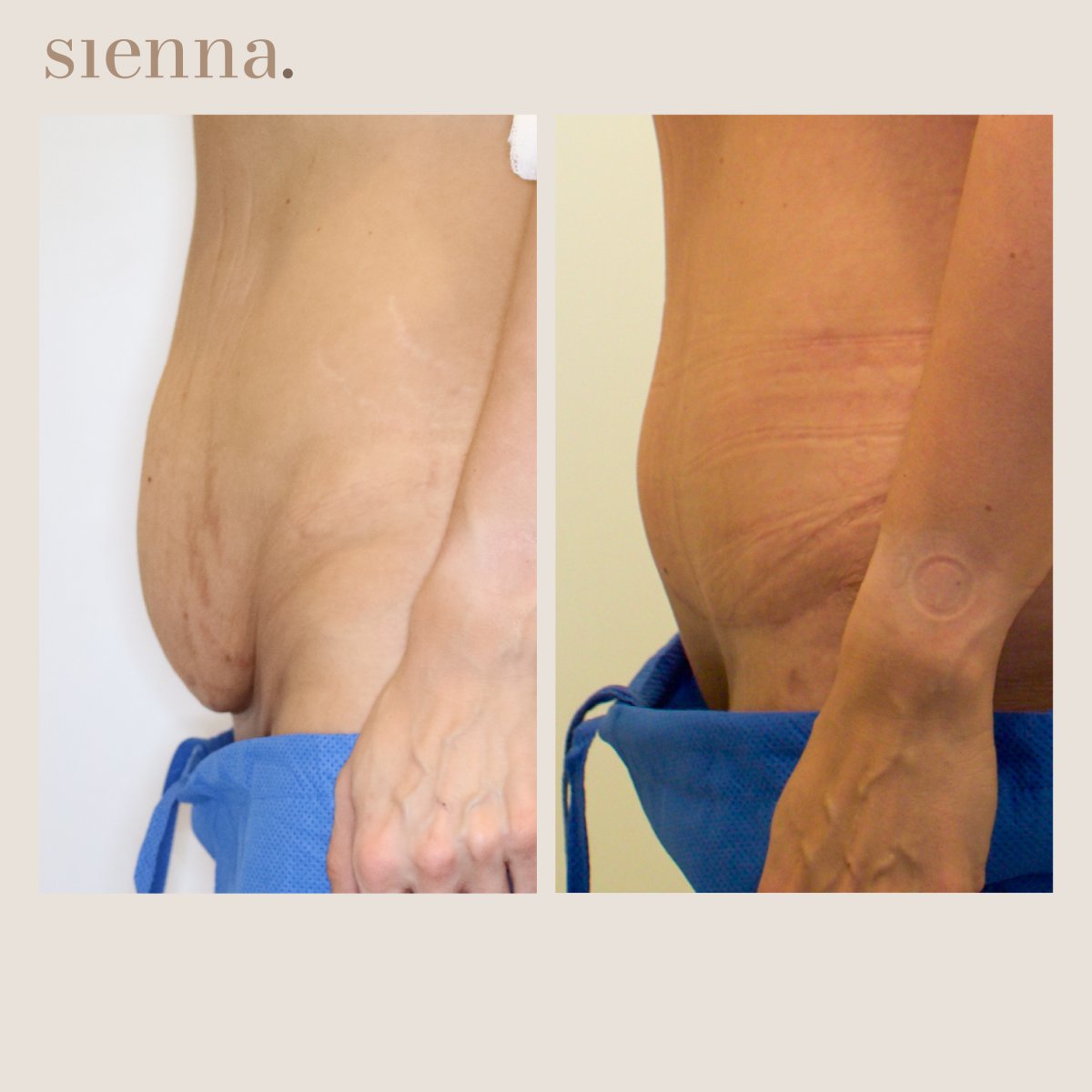 نتائج شد البطن قبل وبعد في Sienna Clinic، تحسين واضح لشكل البطن