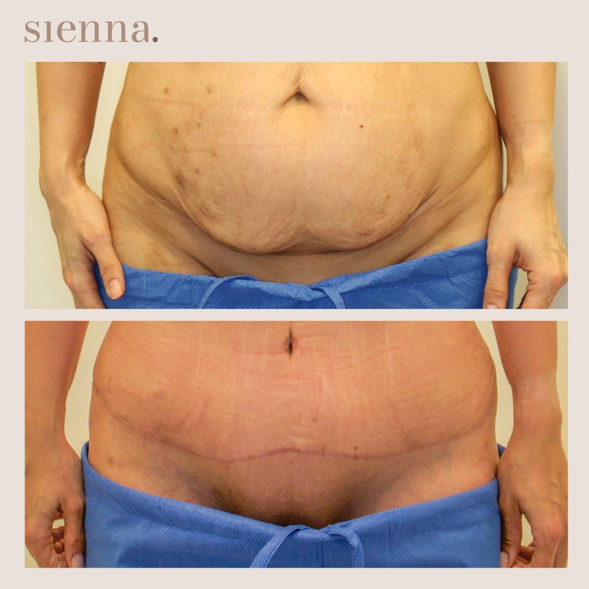 نتائج شد البطن قبل وبعد في Sienna Clinic – تحسين شكل البطن