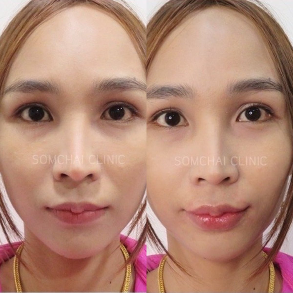 Résultats avant/après de la féminisation faciale à la clinique Somchai, traits adoucis