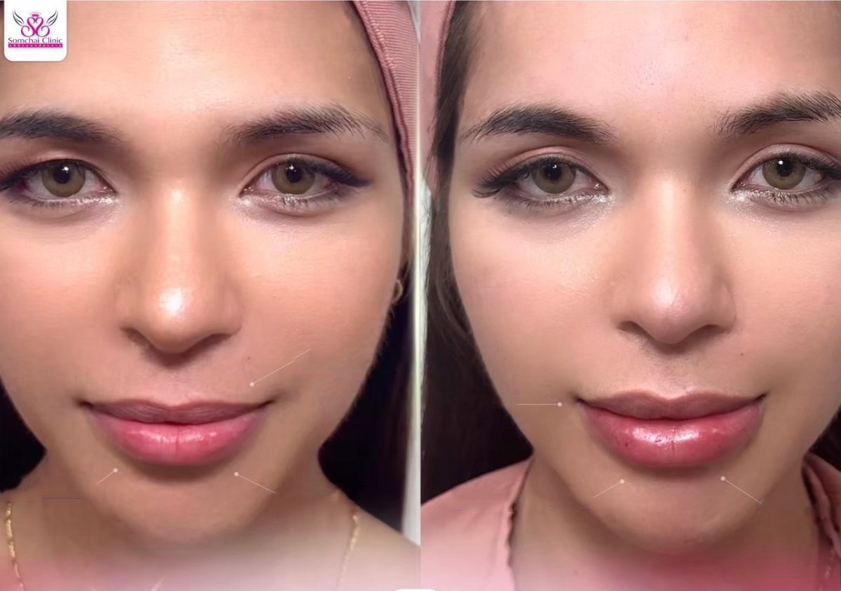 Résultats avant/après de la féminisation faciale à la clinique Somchai, traits affinés