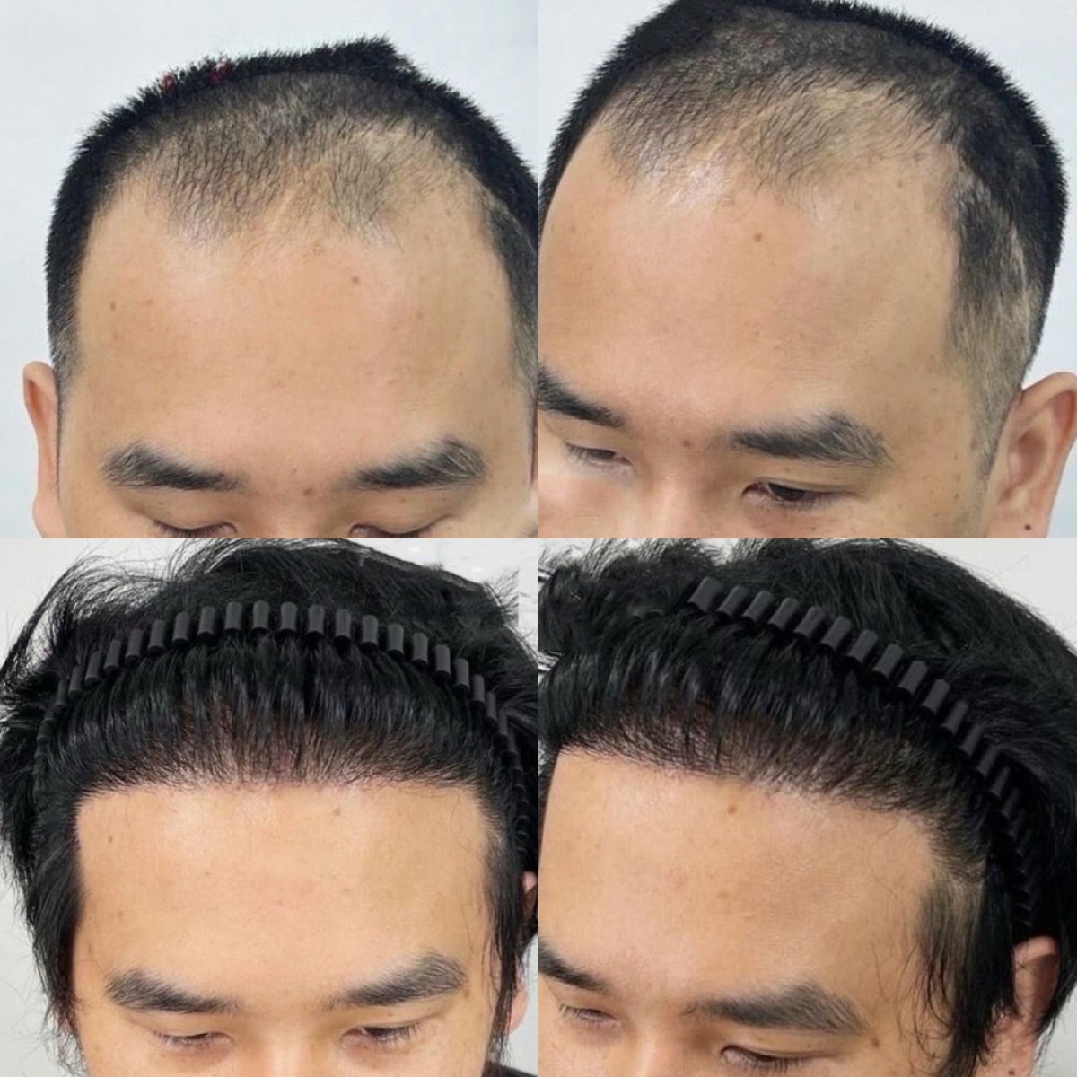 Before and after FUE hair transplant results at ID Clinic Bangkok – restored hairline in male patient