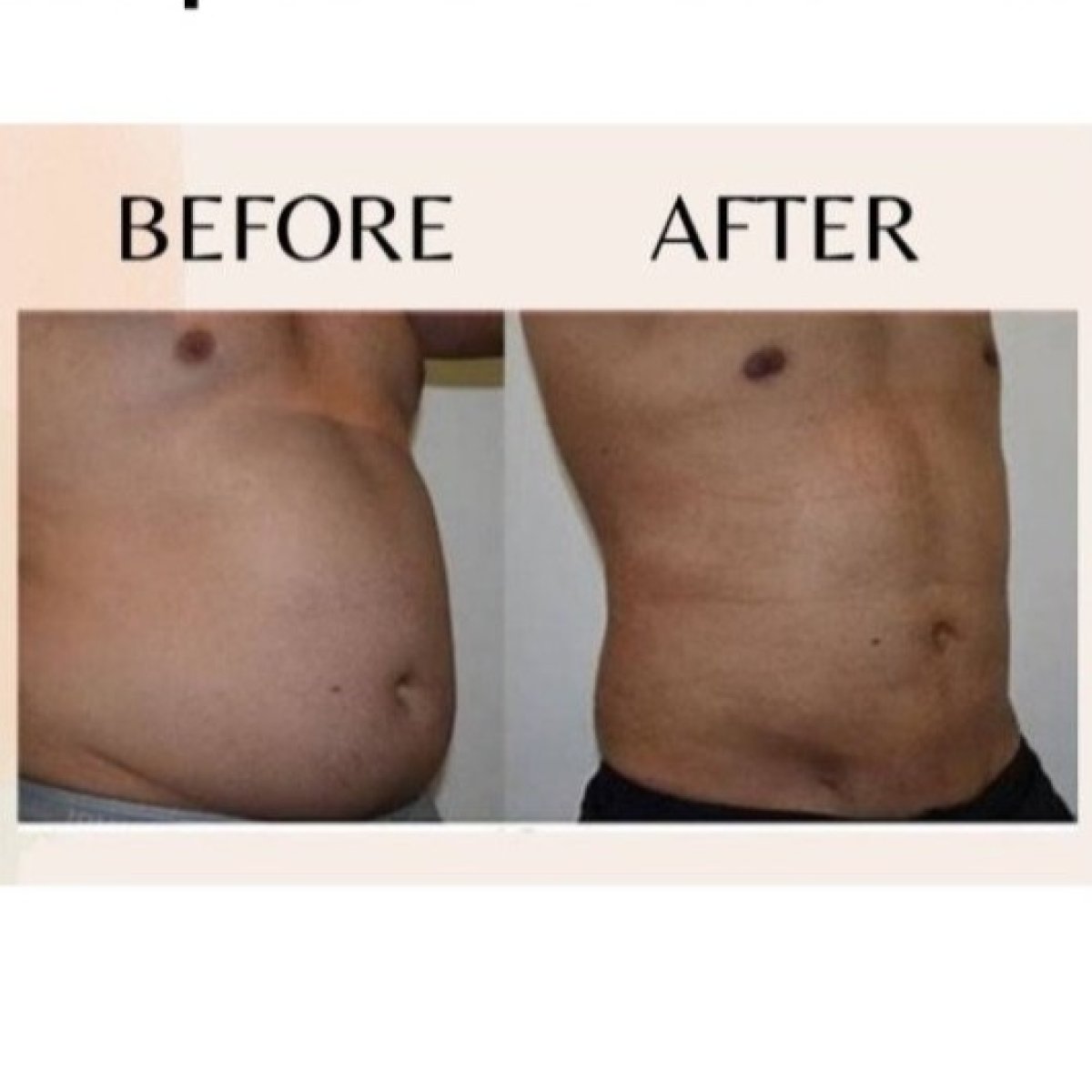 Before and after liposuction result at ID Clinic Bangkok – visible abdominal contour improvement