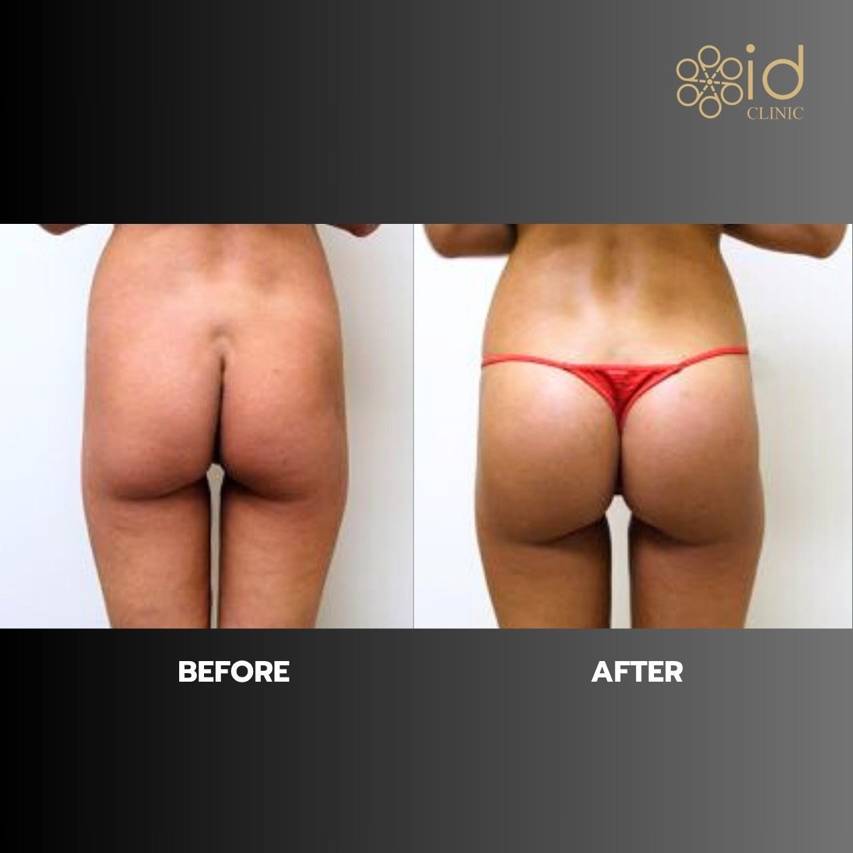 Before and after butt implants at ID Clinic Bangkok, enhanced shape and volume results