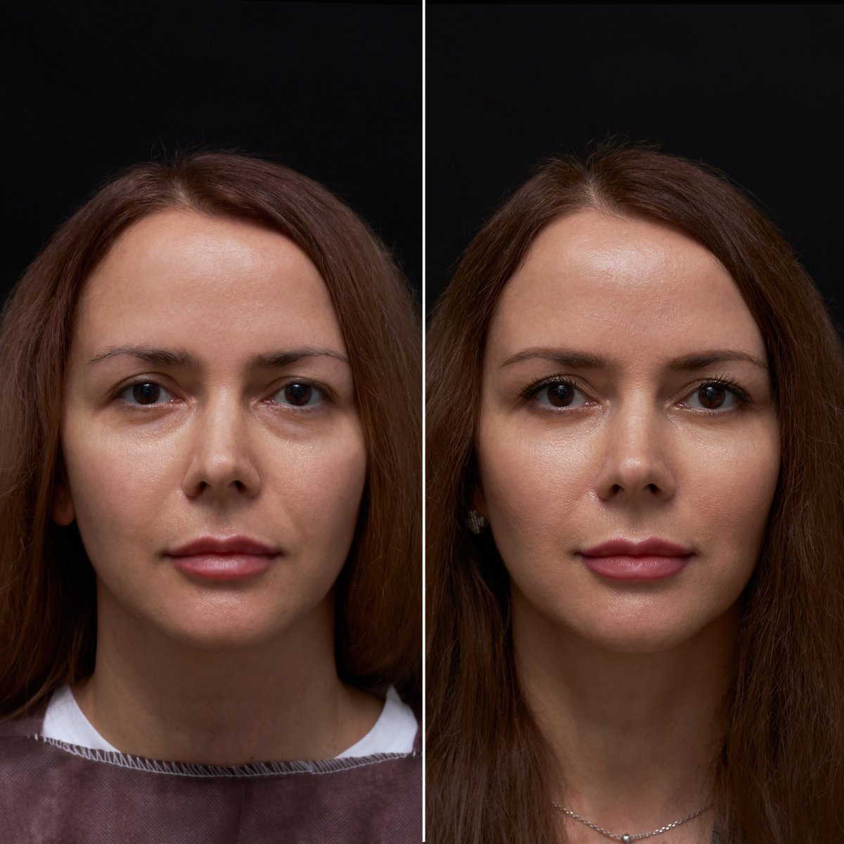 Résultats avant/après blépharoplastie à la Vidnova Clinic, correction des paupières