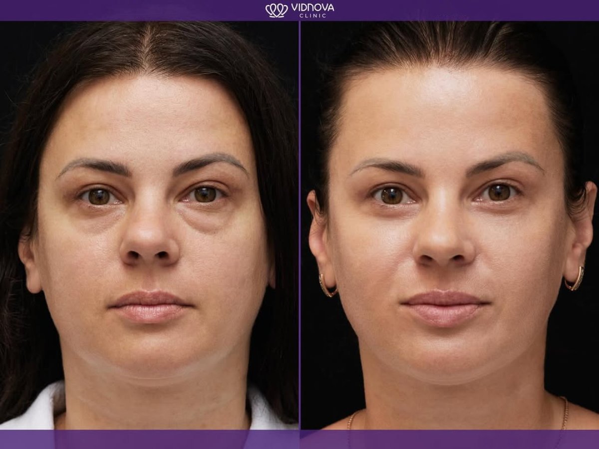 Resultados de blefaroplastia antes y después en Vidnova Clinic, corrección de párpados