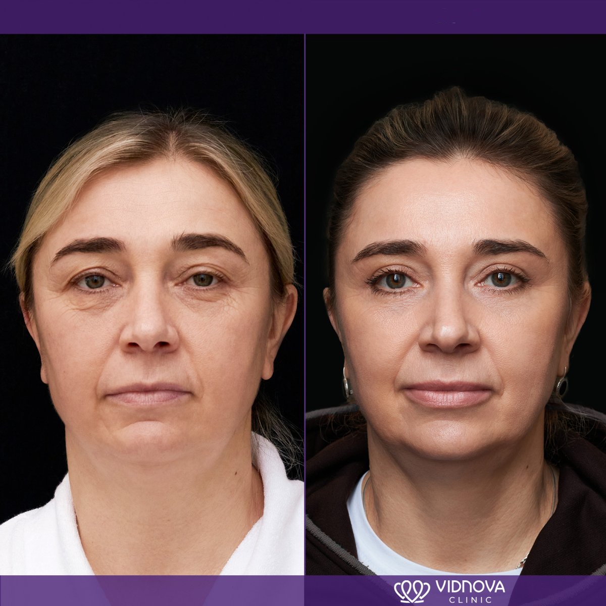 Résultats avant/après blépharoplastie à la Vidnova Clinic, correction des paupières