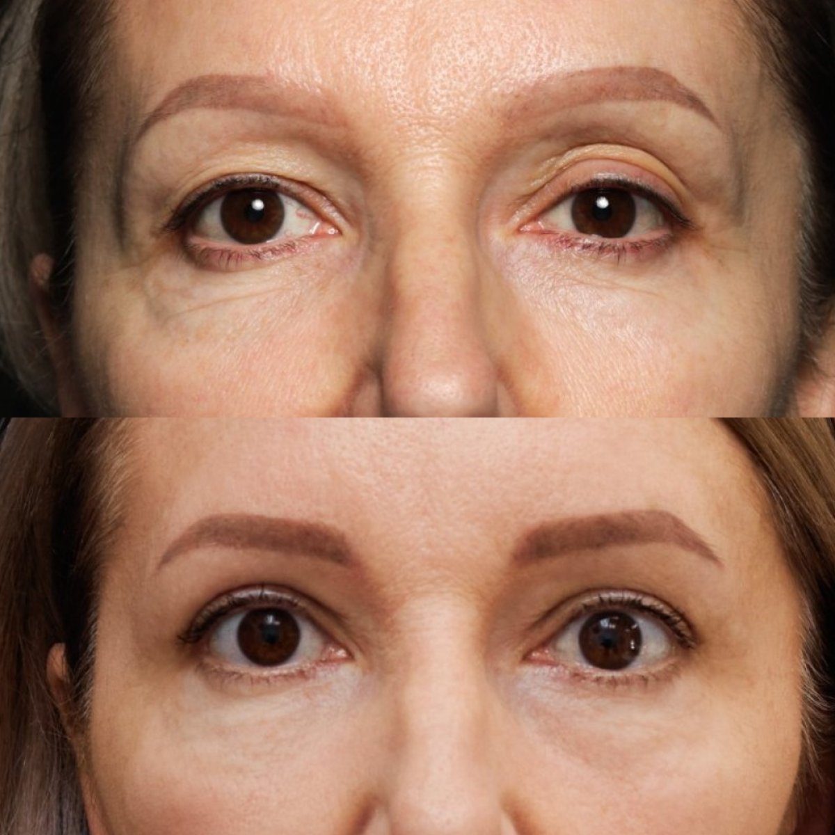 Resultados de blefaroplastia antes y después en Vidnova Clinic – corrección de párpados