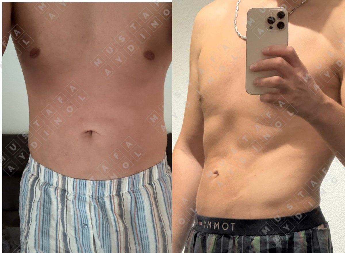 Resultados de liposucción antes y después en Dr. MED – mejor contorno abdominal masculino