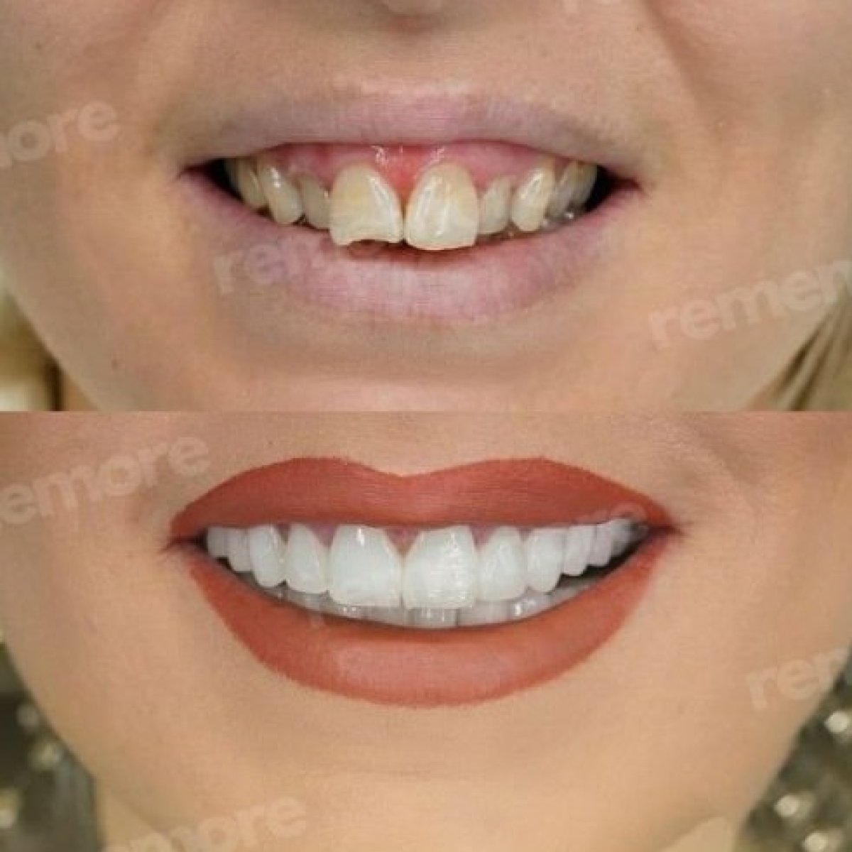 Before and after no prep veneers results at Memorial Şişli Hospital, improved smile aesthetics