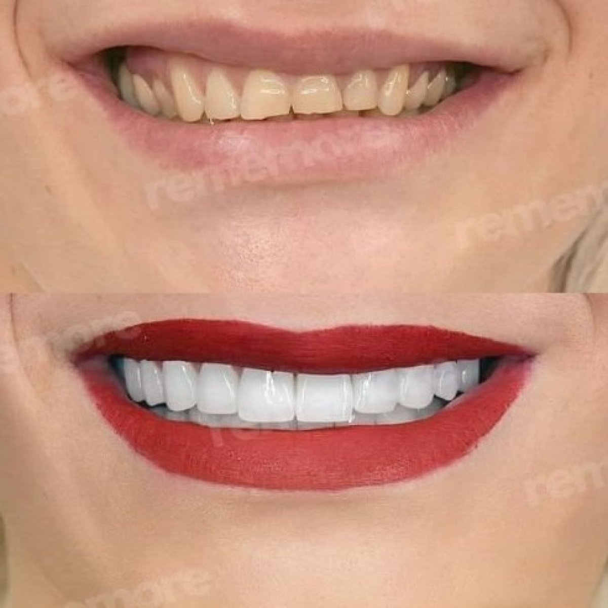 Before and after no prep veneers result at Memorial Şişli Hospital, smile makeover visible