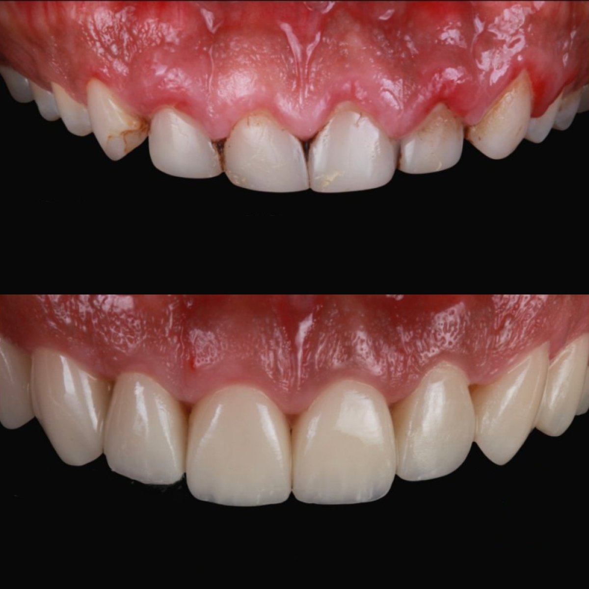 Antes y después de carillas dentales en RO Dental Clinic: sonrisa mejorada y dientes más blancos